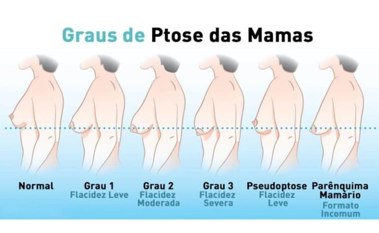 Dr. Octávio Curi Frascareli – Seios caídos após amamentação: por que acontece e quando a cirurgia pode ajudar