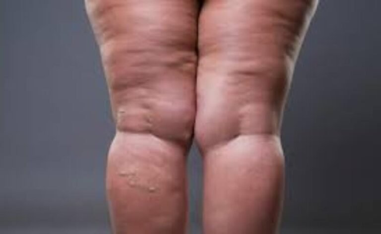 Lipedema deixa de ser invisível e ganha critérios mais claros de diagnóstico