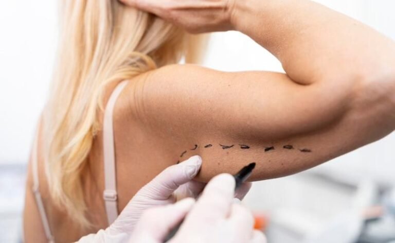 Dr. Octávio Curi Frascareli – Braquioplastia: como tratar a flacidez nos braços de forma definitiva