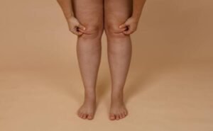 Lipedema: por que tantas mulheres convivem com dor, inchaço e anos de frustração antes do diagnóstico